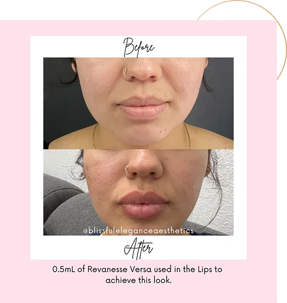 Dermal Fillers for Lips