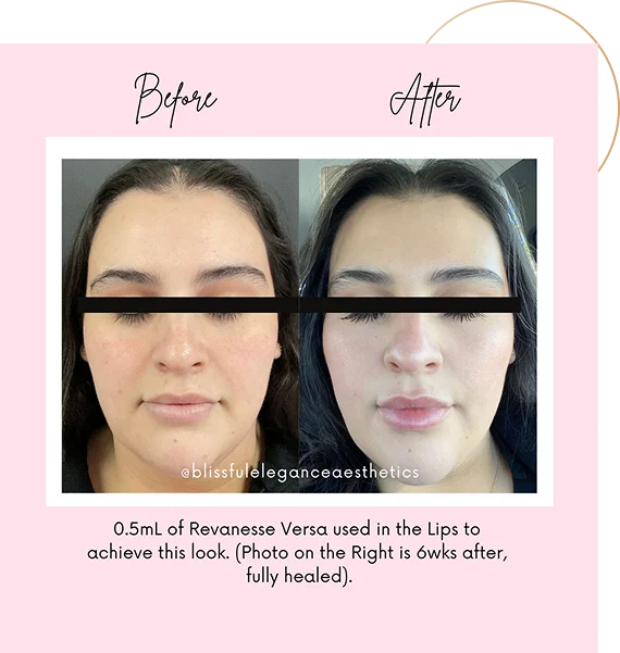 Dermal Fillers for Cheeks