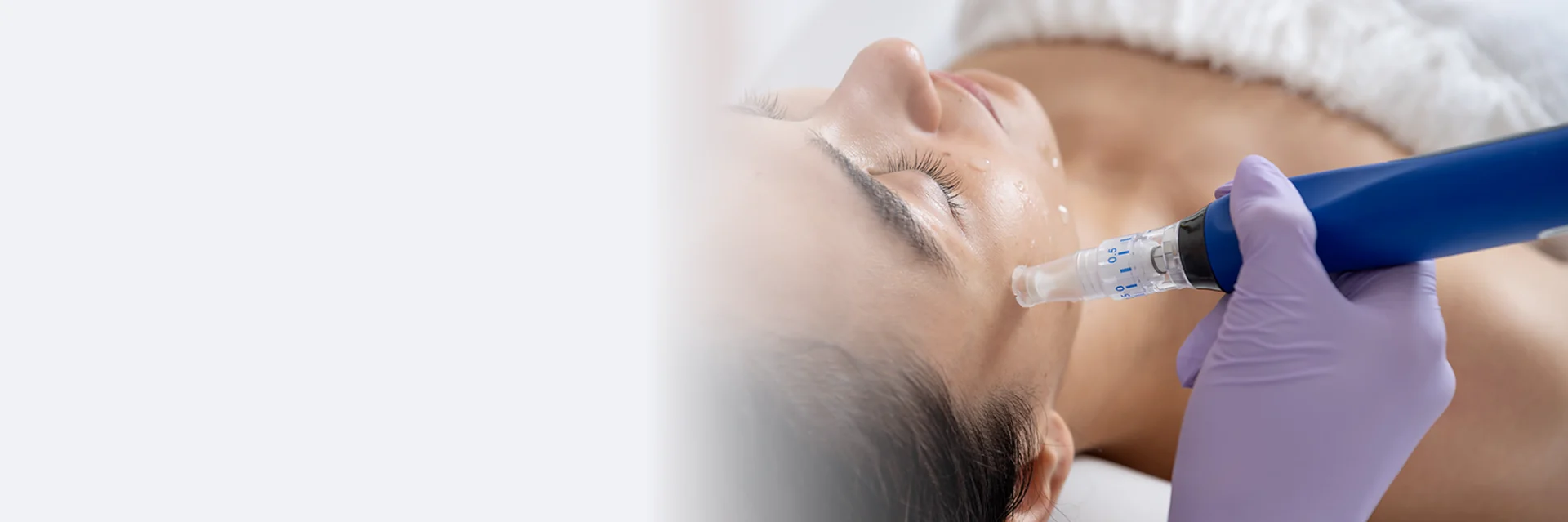 PRP Treatment and Microneedling