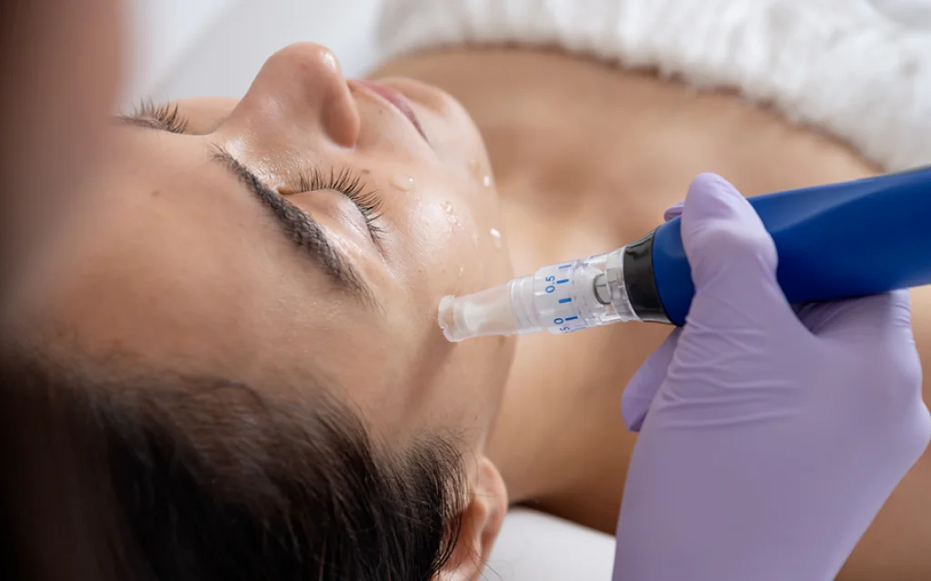 PRP Treatment and Microneedling