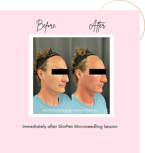 Blissful Elegance for PRP and Microneedling in San Diego