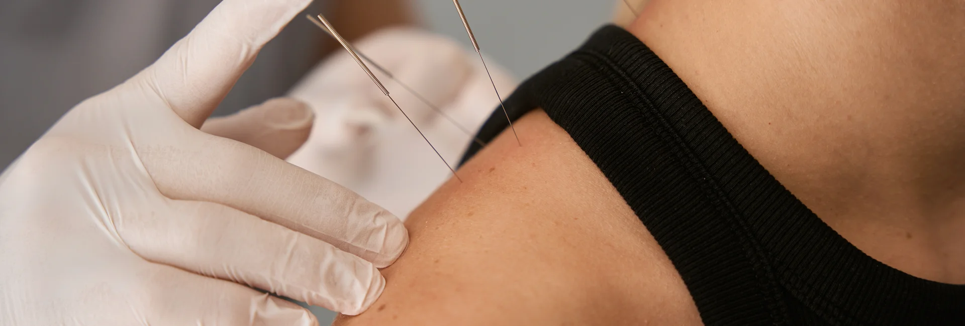 Sports medicine acupuncture in San Diego treatment room