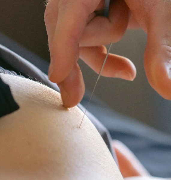 Sports Medicine Acupuncture