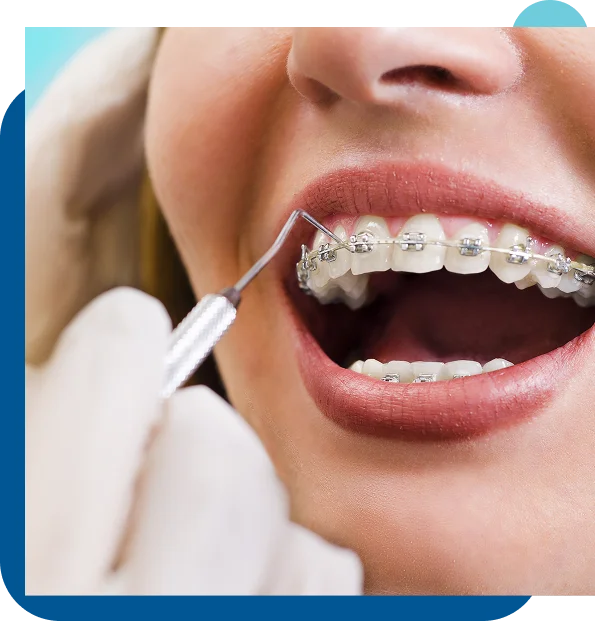 Do You Need Braces? Here’s How to Know