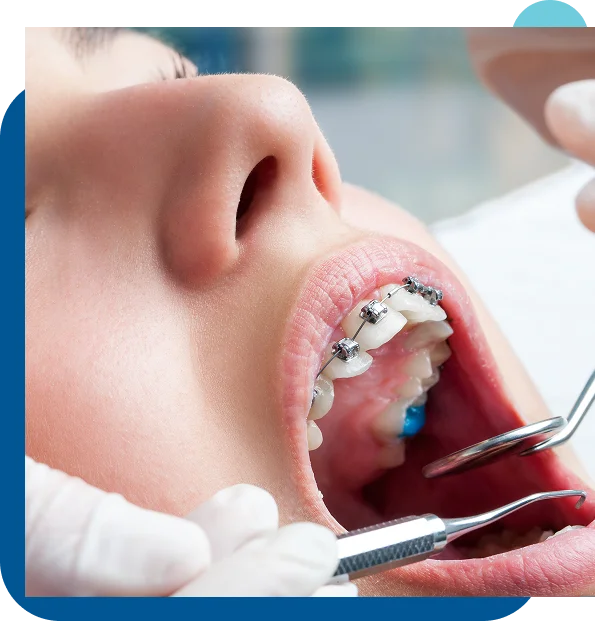 Traditional Metal Braces in San Marcos - Durable, Affordable, and Effective