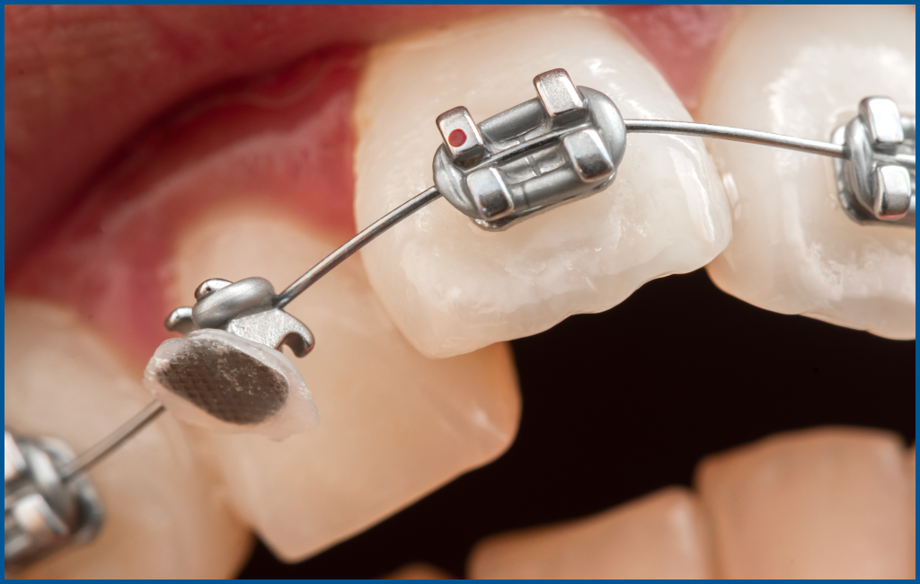 Emergency Orthodontic Treatment​