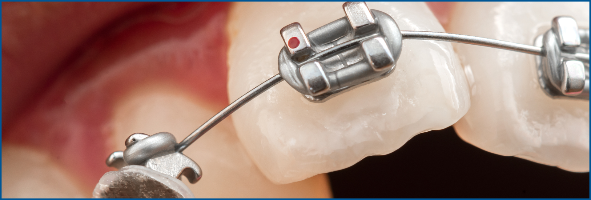 Emergency Orthodontic Treatment​