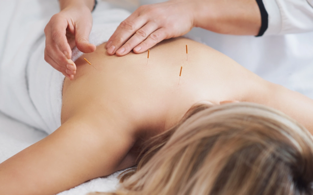 Acupuncture for Pain Relief &amp; Healing - Start Feeling Better Today