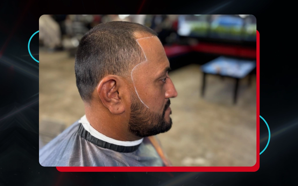 Scalp Micropigmentation For Women