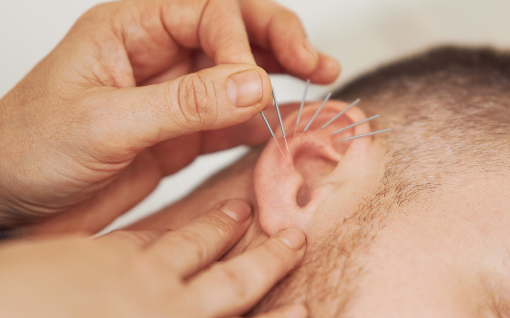 NADA Ear Acupuncture & Ear Seed Therapy