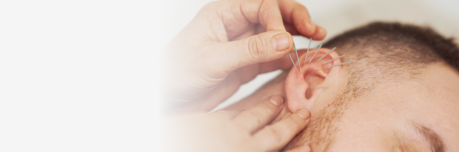 NADA Ear Acupuncture & Ear Seed Therapy