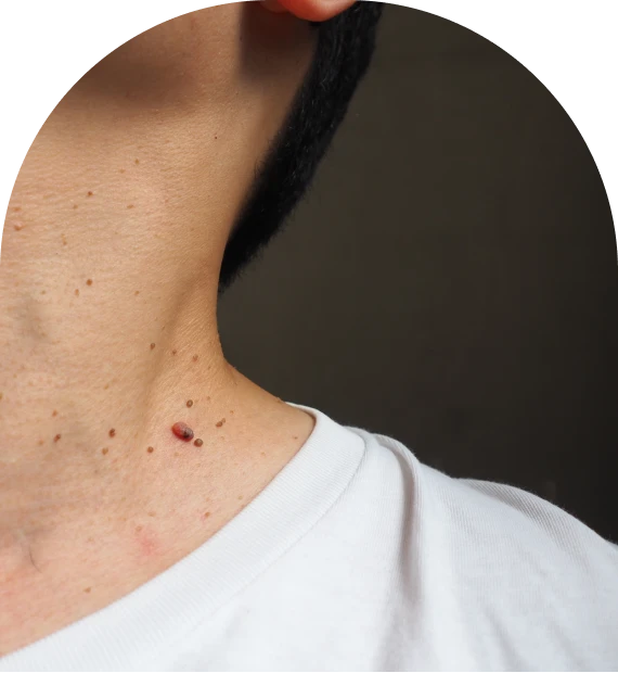 Sun Spot Removal Treatment to Restore an Even, Healthy Skin Tone