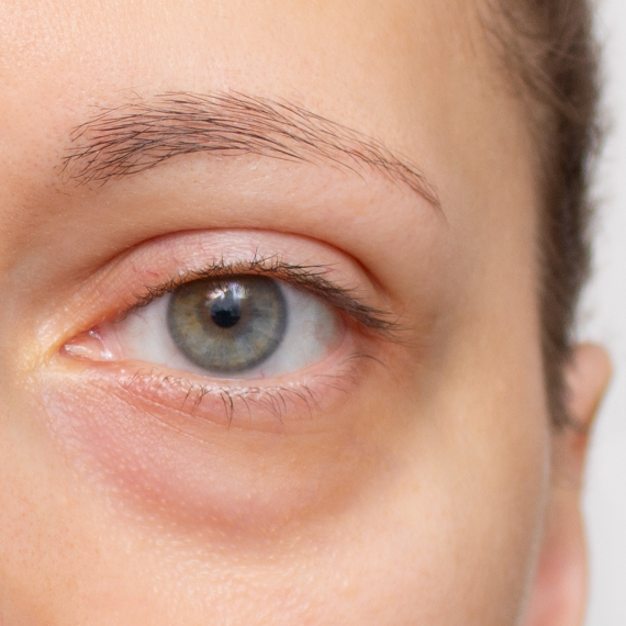 Puffiness and Swelling