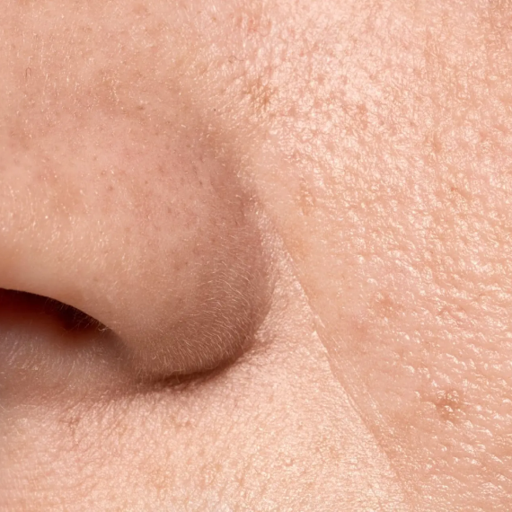 Fine Lines and Wrinkles