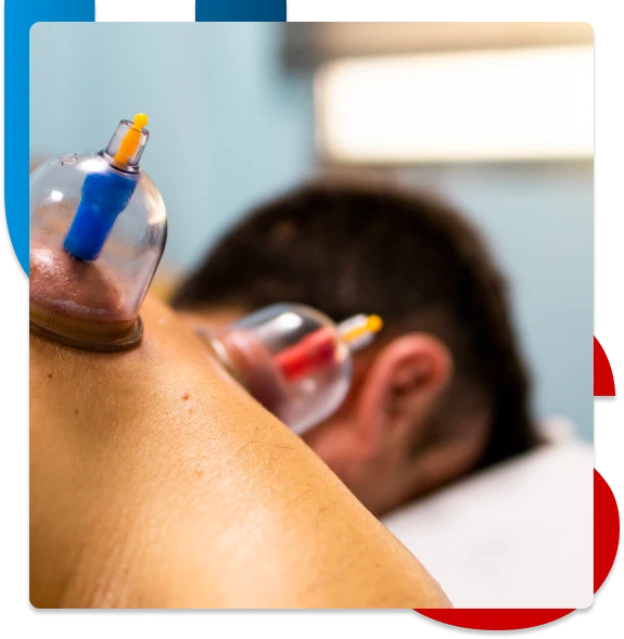 cupping benefits