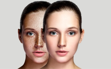Dark Spot & Pigmentation Removal Services