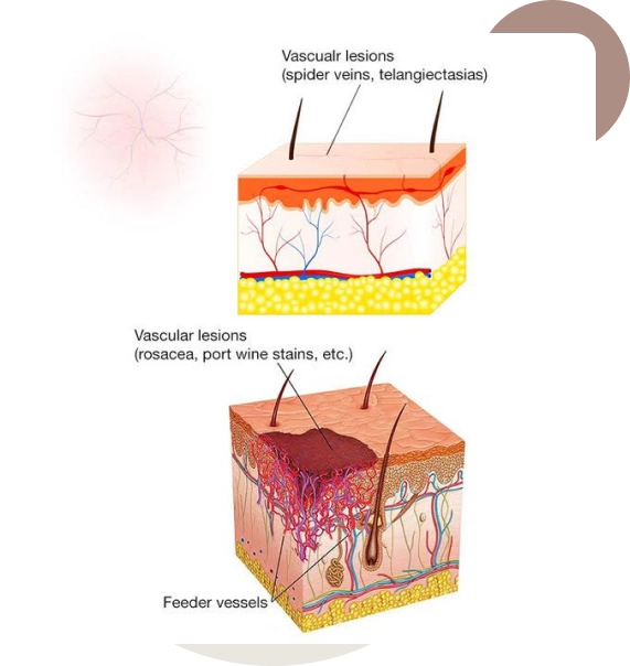 Understanding Vascular Lesion Variants