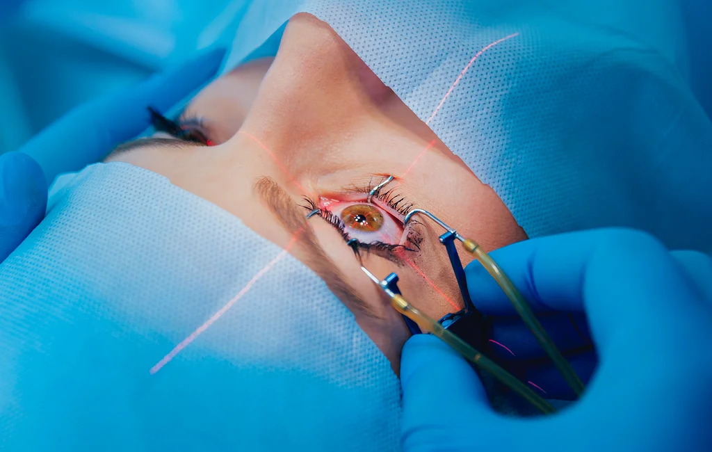 Refractive Surgery Co Management