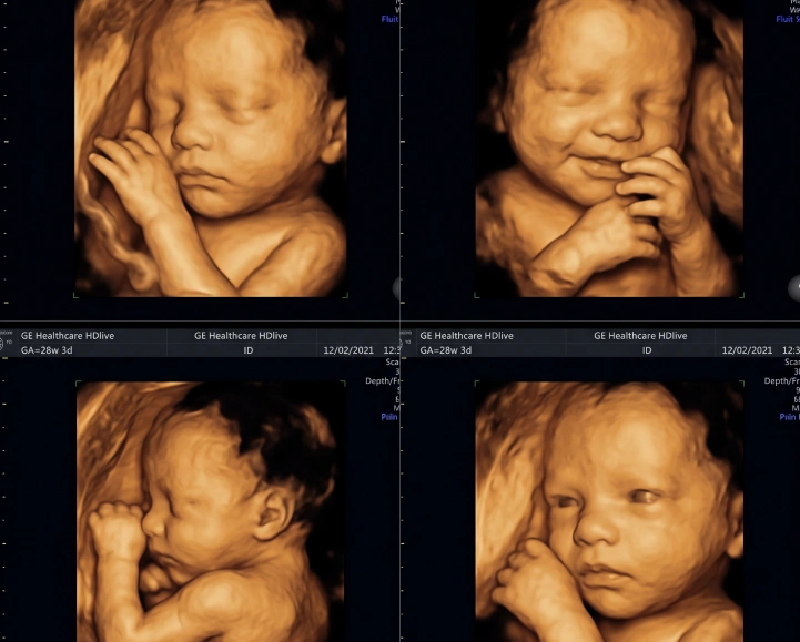 3D and 4D pregnancy imaging