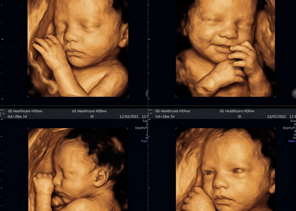 Advanced 3D and 4D pregnancy scan imaging