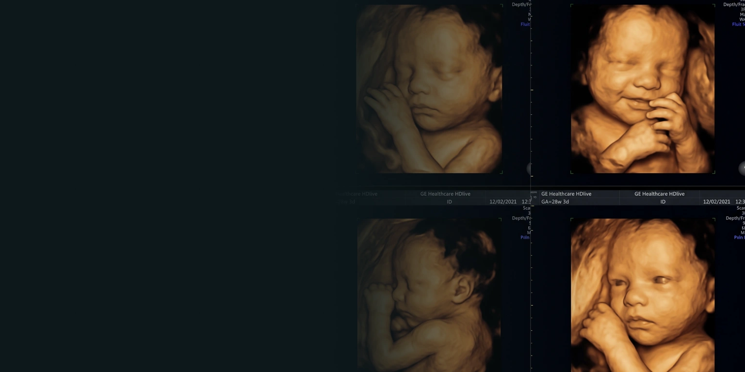 Advanced 3D and 4D pregnancy scan imaging